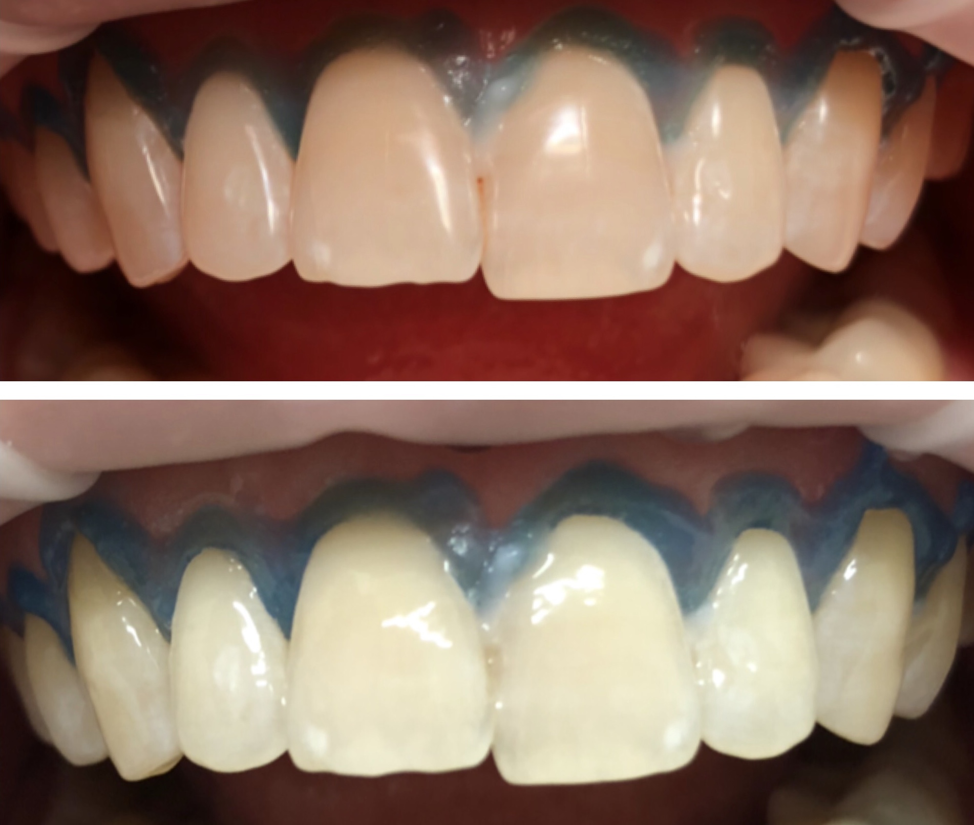 отбеливание зубов системой Amazing white