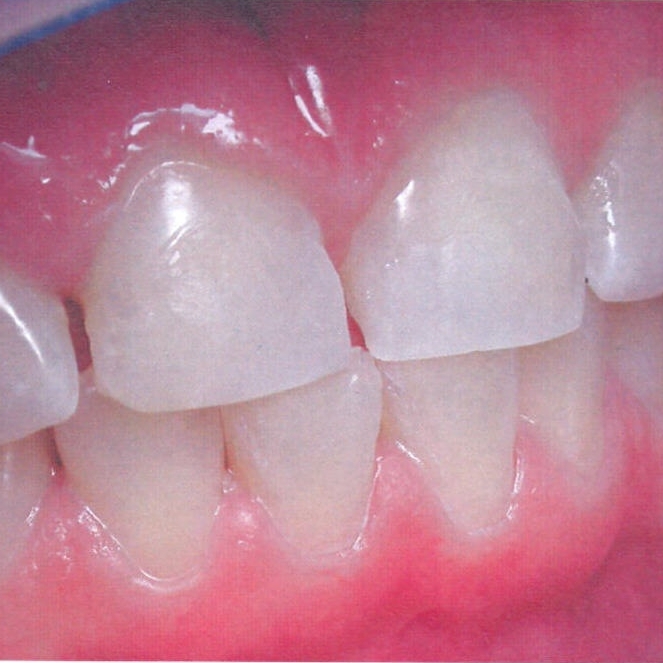 Реставрация разрушенной коронковой части зуба